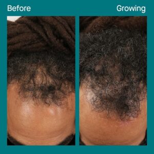 nutrafol-hair-before-after-1 1