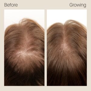 nutrafol-hair-before-after-1 2