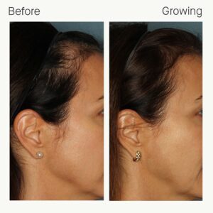 nutrafol-hair-before-after-1 3