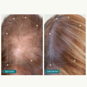 nutrafol-hair-before-after-1 4
